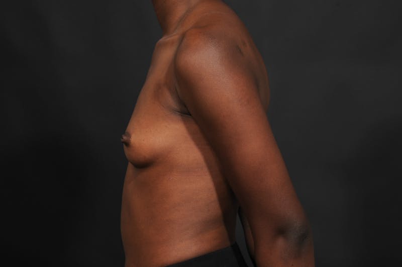 Breast Augmentation Before & After Gallery - Patient 156745721 - Image 9