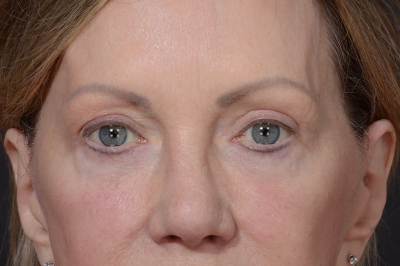 Blepharoplasty Before & After Gallery - Patient 156745736 - Image 2