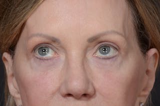Blepharoplasty Before & After Gallery - Patient 156745736 - Image 4