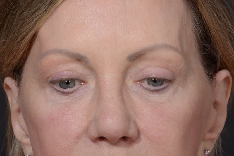 Blepharoplasty Before & After Gallery - Patient 156745736 - Image 6