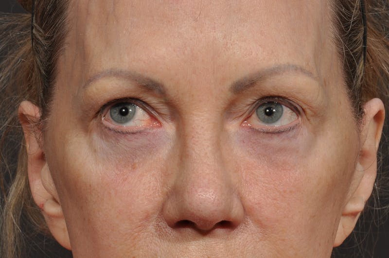 Blepharoplasty Before & After Gallery - Patient 156745736 - Image 3