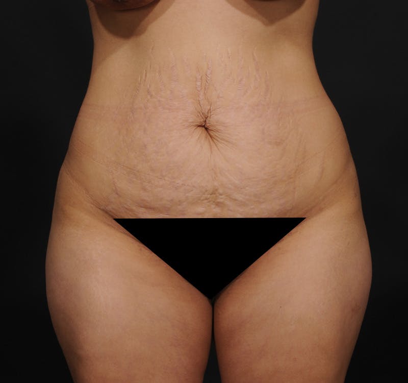 Tummy Tuck Before & After Gallery - Patient 156819563 - Image 1