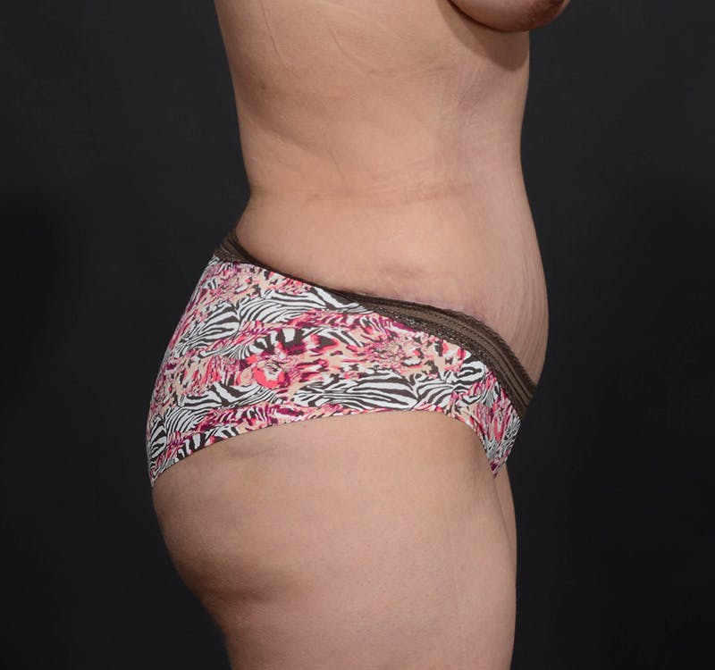 Tummy Tuck Before & After Gallery - Patient 156819563 - Image 6