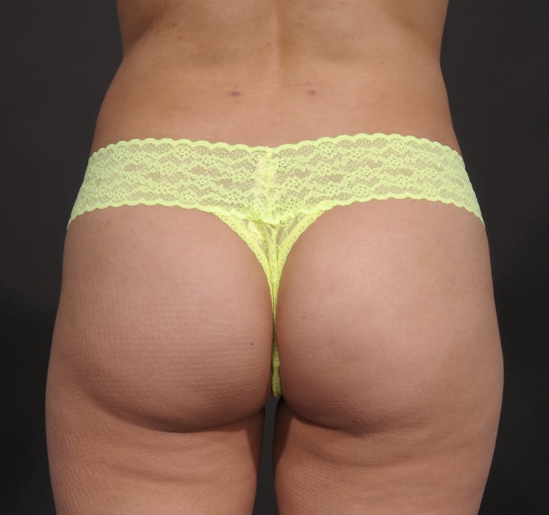 Brazilian Butt Lift Before & After Gallery - Patient 156819576 - Image 2