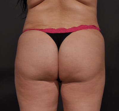 Brazilian Butt Lift Before & After Gallery - Patient 156819608 - Image 2