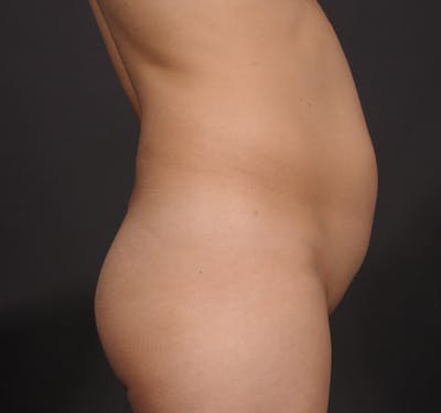 Liposuction Before & After Gallery - Patient 156819630 - Image 1