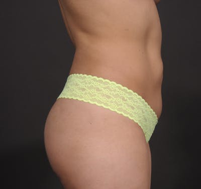 Liposuction Before & After Gallery - Patient 156819630 - Image 2