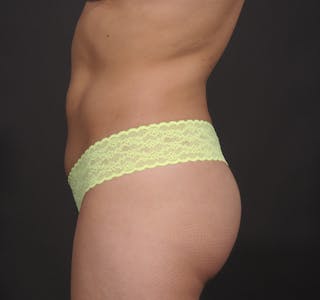 Liposuction Before & After Gallery - Patient 156819630 - Image 4
