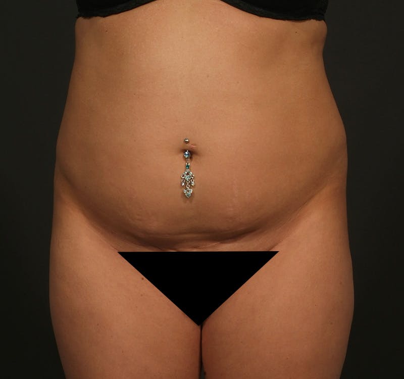 Liposuction Before & After Gallery - Patient 156819629 - Image 1