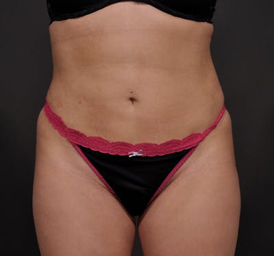 Liposuction Before & After Gallery - Patient 156819629 - Image 2
