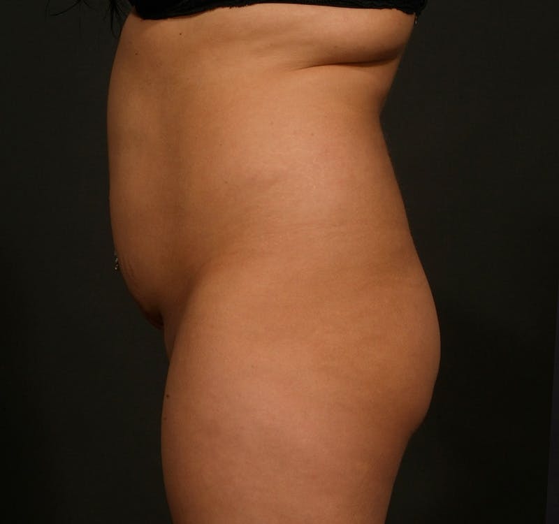 Liposuction Before & After Gallery - Patient 156819629 - Image 7