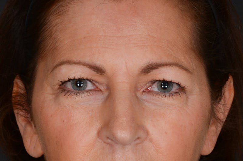 Blepharoplasty Before & After Gallery - Patient 155407963 - Image 1