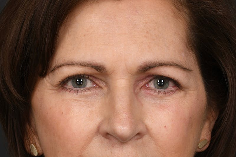 Blepharoplasty Before & After Gallery - Patient 155407963 - Image 2