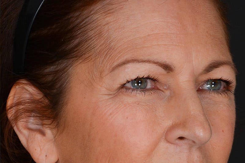 Blepharoplasty Before & After Gallery - Patient 155407963 - Image 3