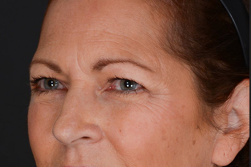 Blepharoplasty Before & After Gallery - Patient 155407963 - Image 7