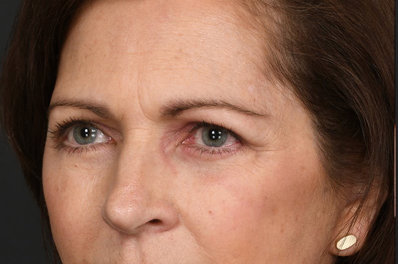 Blepharoplasty Before & After Gallery - Patient 155407963 - Image 8