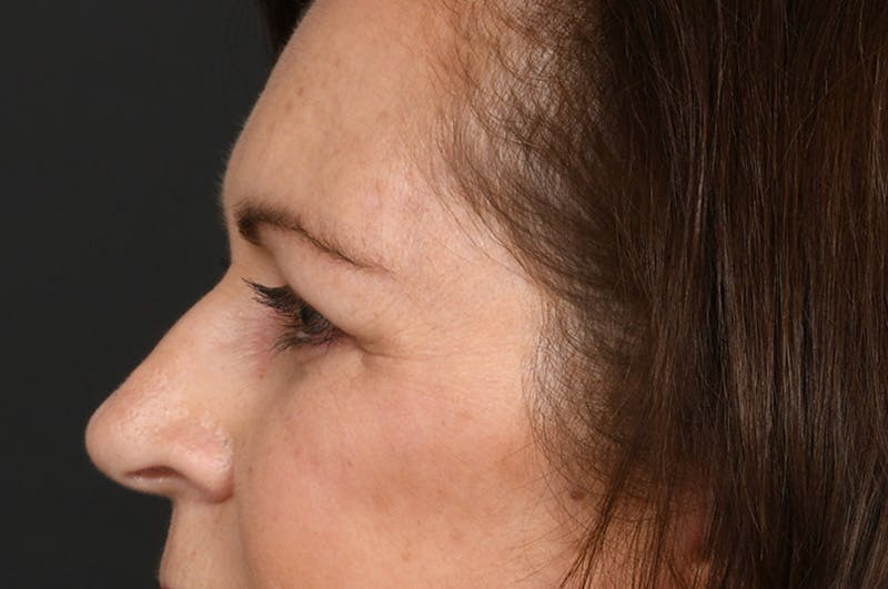 Blepharoplasty Before & After Gallery - Patient 155407963 - Image 10