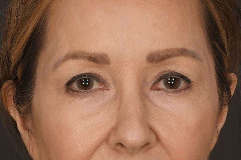 Blepharoplasty Before & After Gallery - Patient 155407959 - Image 1