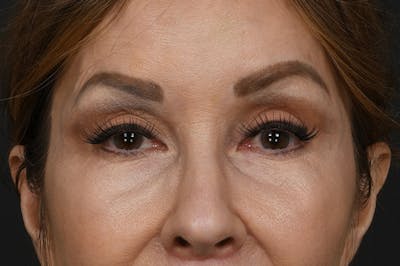 Blepharoplasty Before & After Gallery - Patient 155407959 - Image 2