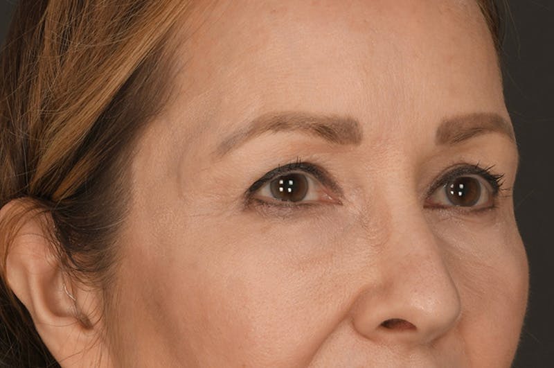 Blepharoplasty Before & After Gallery - Patient 155407959 - Image 3