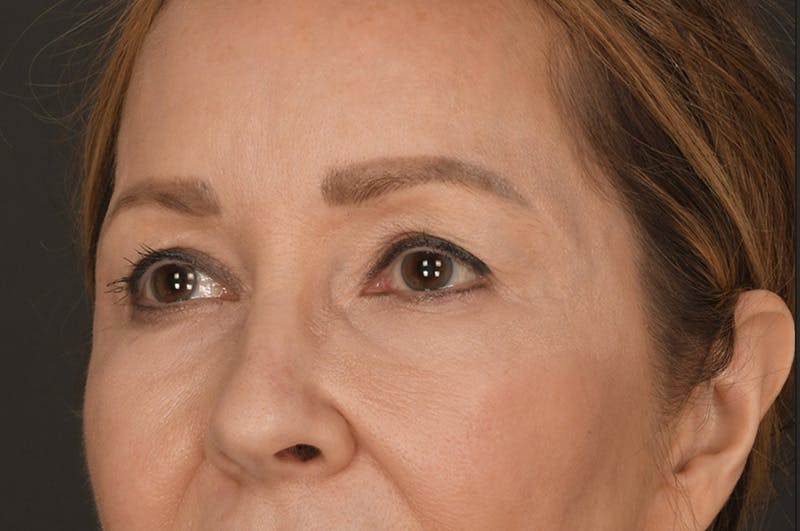 Blepharoplasty Before & After Gallery - Patient 155407959 - Image 7