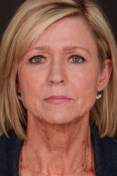 Neck Lift Before & After Gallery - Patient 165625775 - Image 1