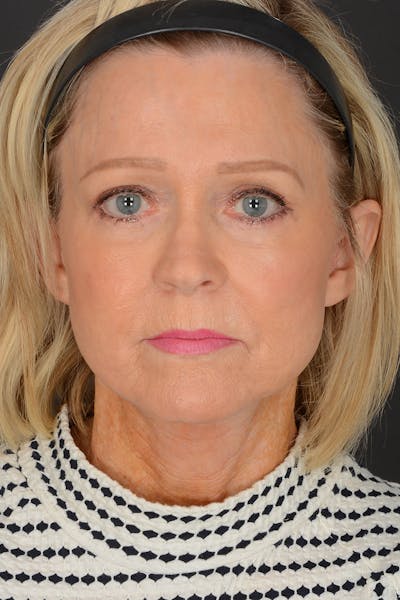 Neck Lift Before & After Gallery - Patient 165625775 - Image 2