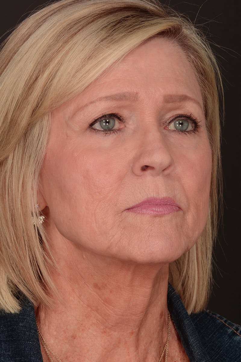 Neck Lift Before & After Gallery - Patient 165625775 - Image 3