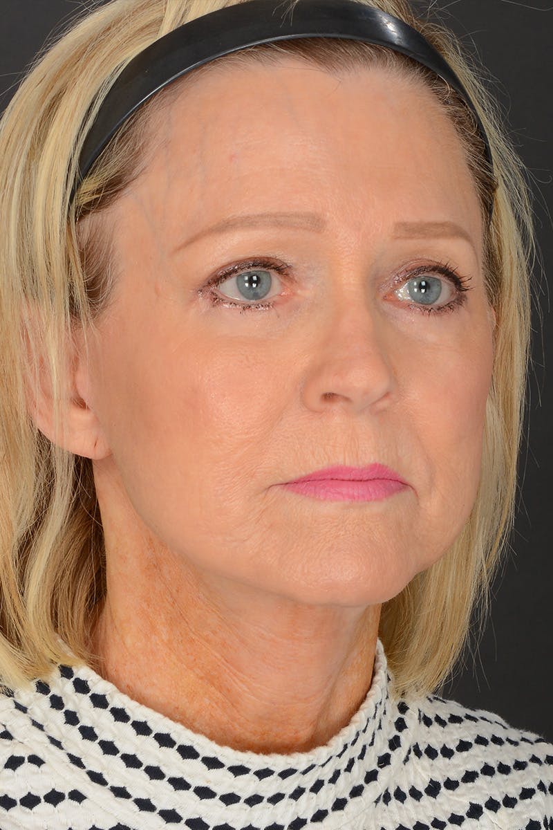 Neck Lift Before & After Gallery - Patient 165625775 - Image 4