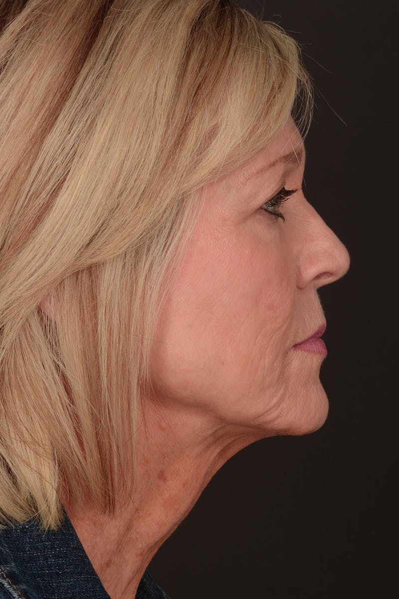Neck Lift Before & After Gallery - Patient 165625775 - Image 5