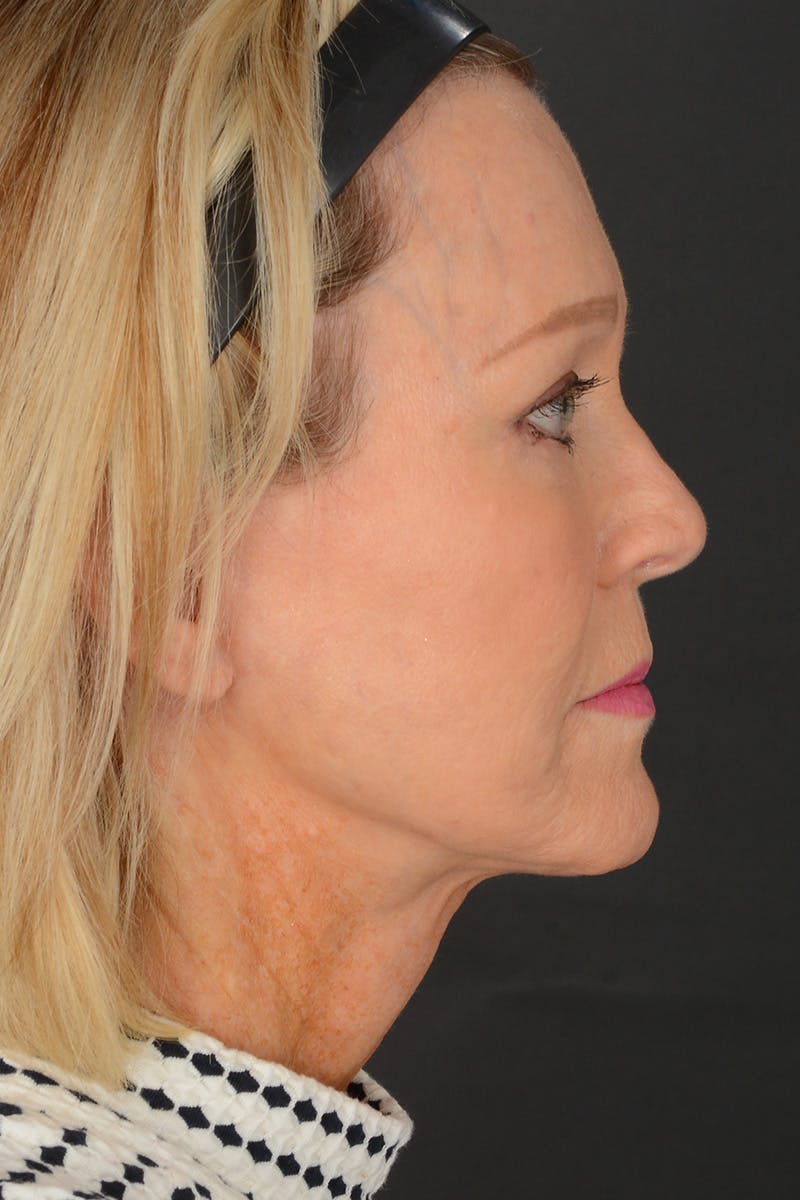 Neck Lift Before & After Gallery - Patient 165625775 - Image 6