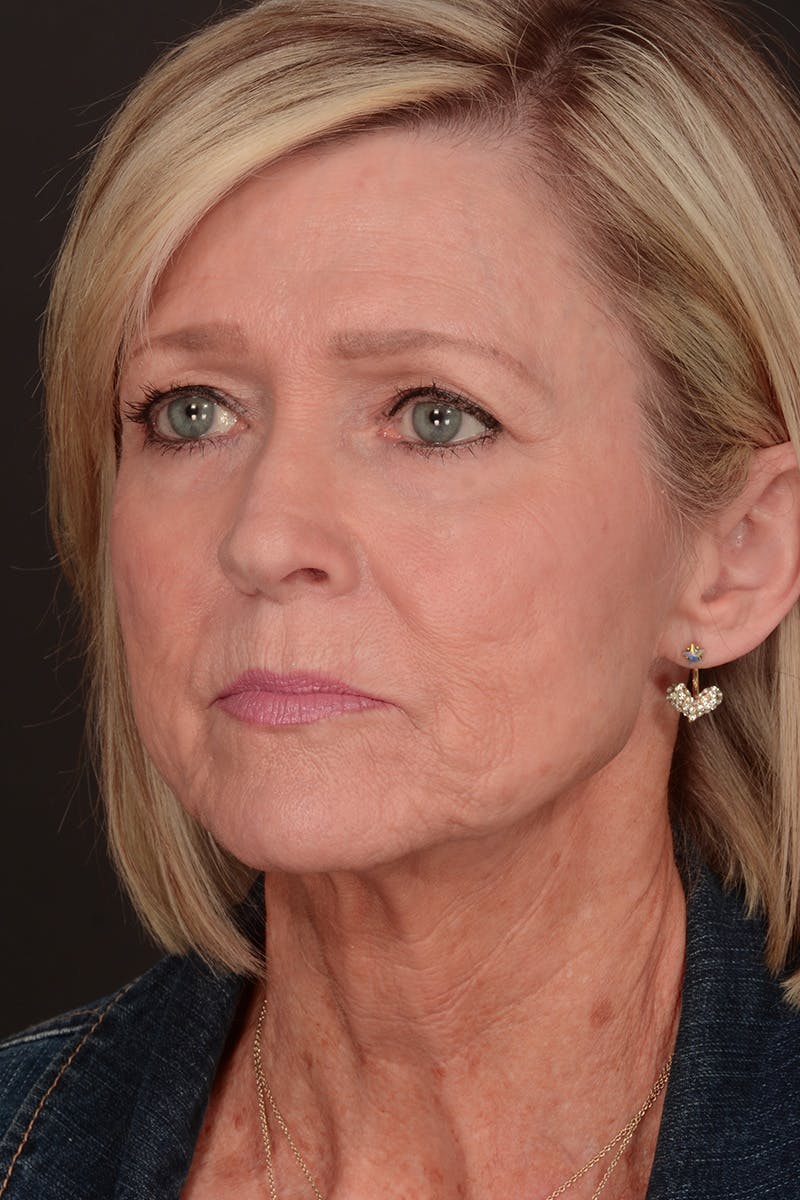 Neck Lift Before & After Gallery - Patient 165625775 - Image 9
