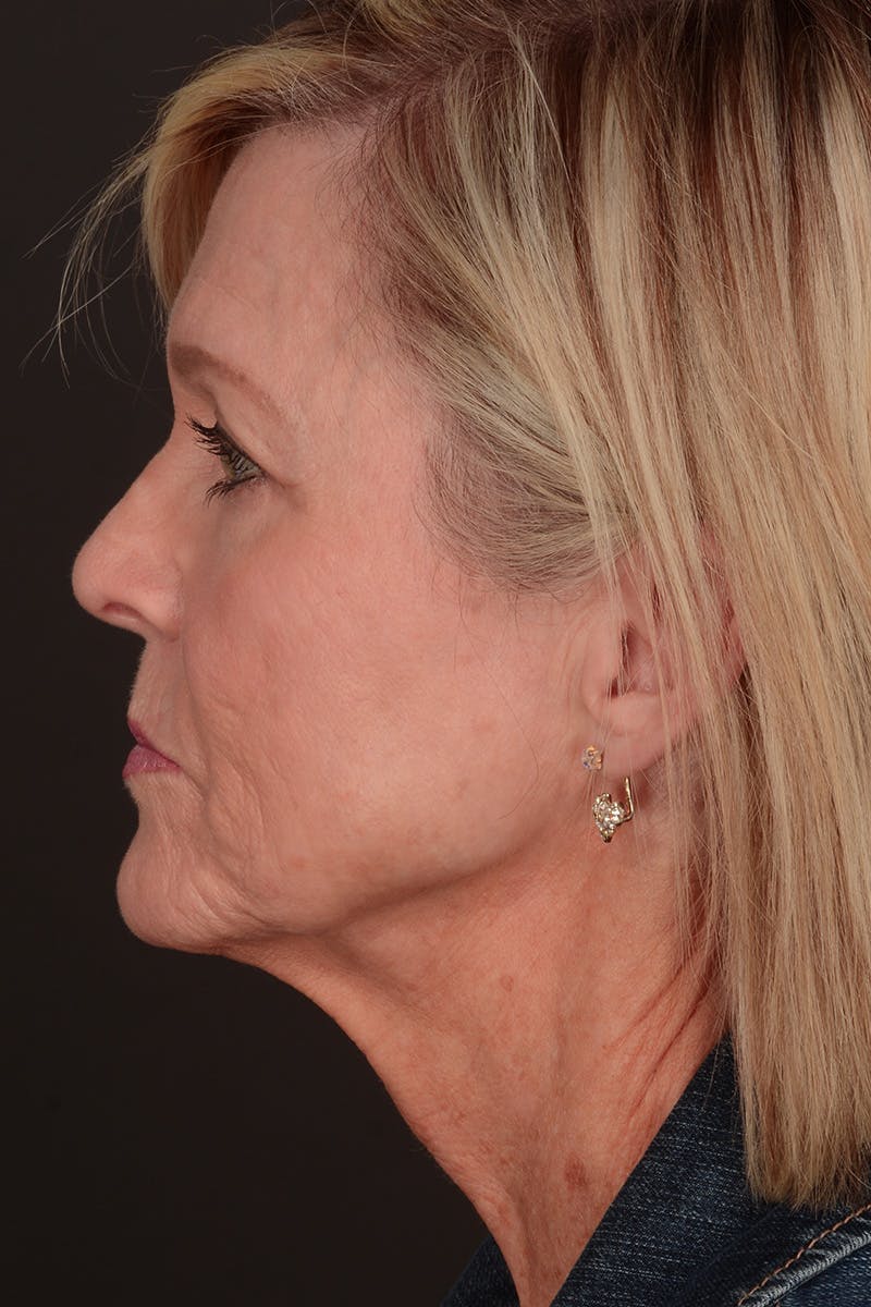 Neck Lift Before & After Gallery - Patient 165625775 - Image 11