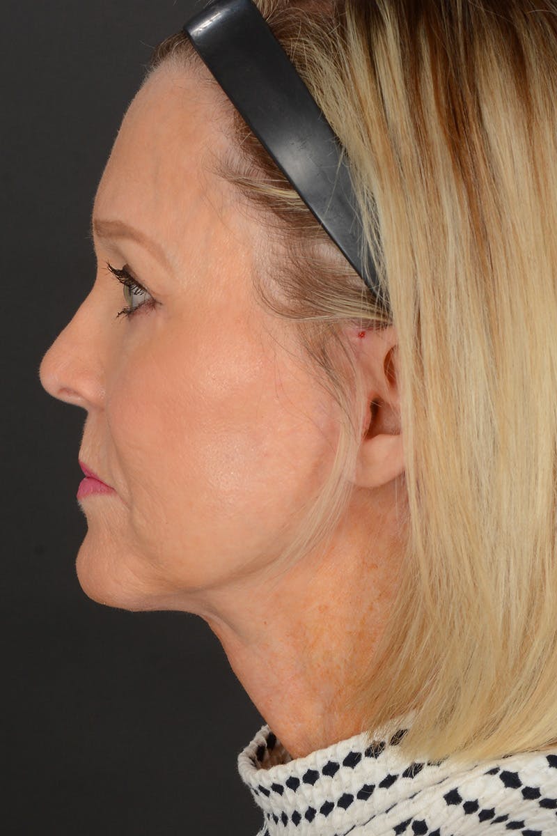 Neck Lift Before & After Gallery - Patient 165625775 - Image 12