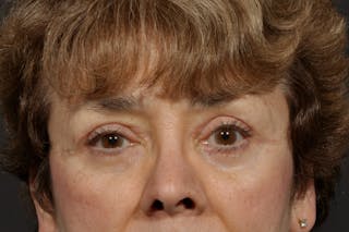 Blepharoplasty Before & After Gallery - Patient 165627433 - Image 2