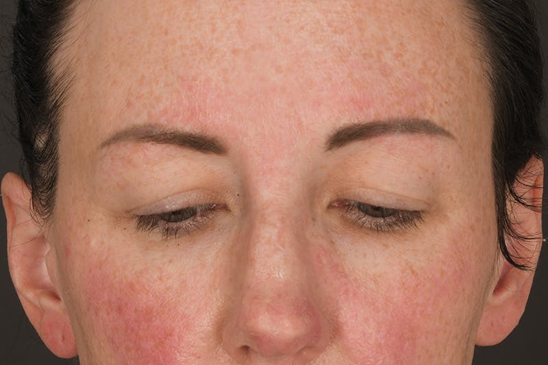 Blepharoplasty Before & After Gallery - Patient 165627434 - Image 3