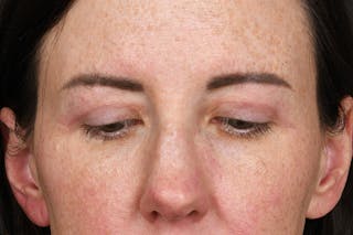 Blepharoplasty Before & After Gallery - Patient 165627434 - Image 4