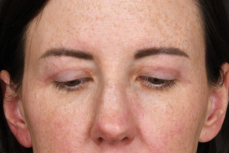 Blepharoplasty Before & After Gallery - Patient 165627434 - Image 4
