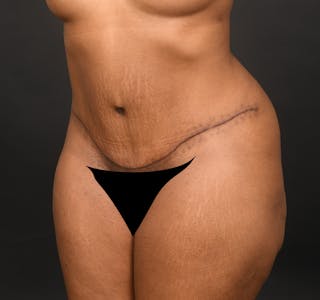 Tummy Tuck Before & After Gallery - Patient 165627461 - Image 4