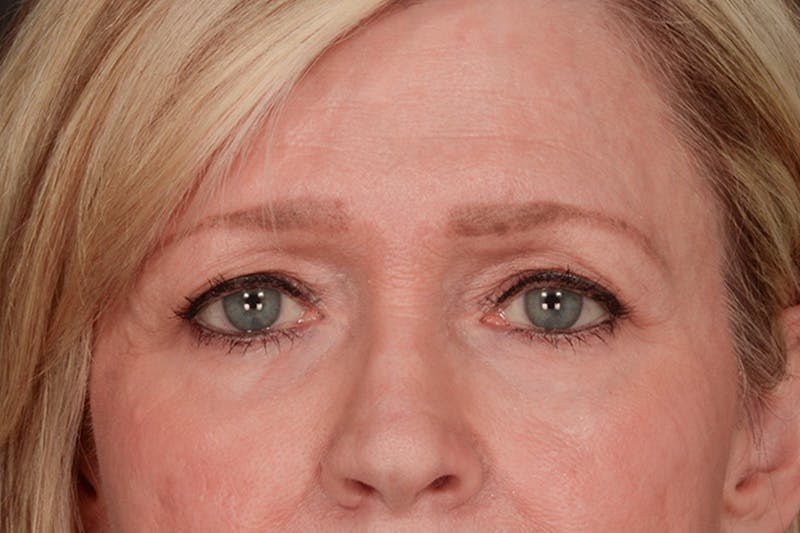 Blepharoplasty Before & After Gallery - Patient 165625802 - Image 1