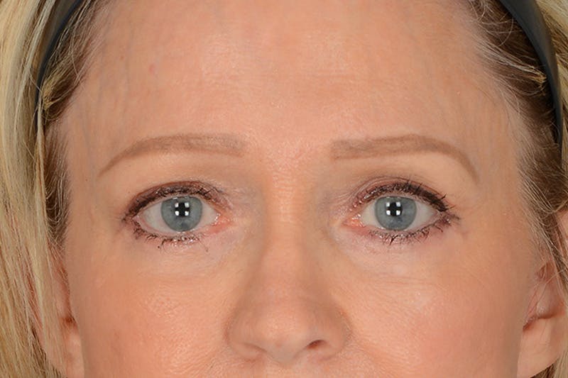 Blepharoplasty Before & After Gallery - Patient 797407 - Image 2
