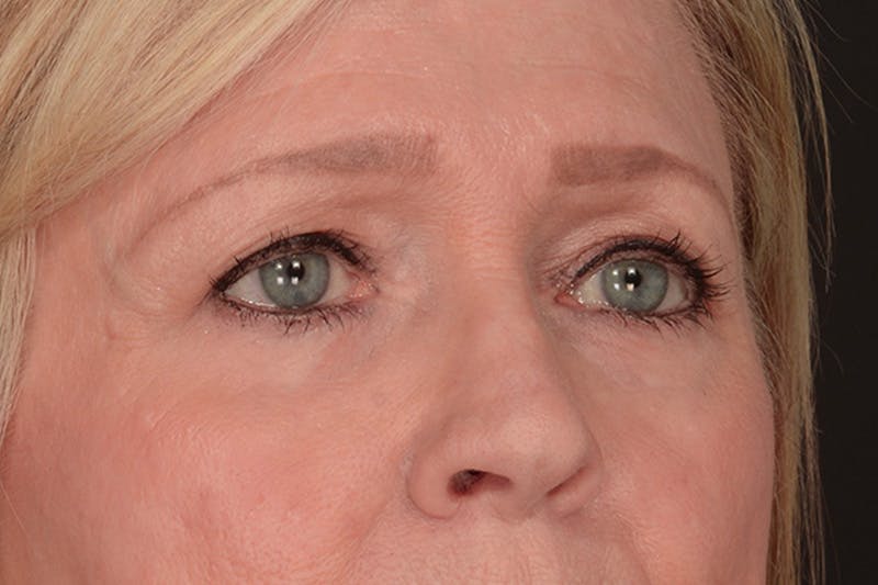 Blepharoplasty Before & After Gallery - Patient 165625802 - Image 3