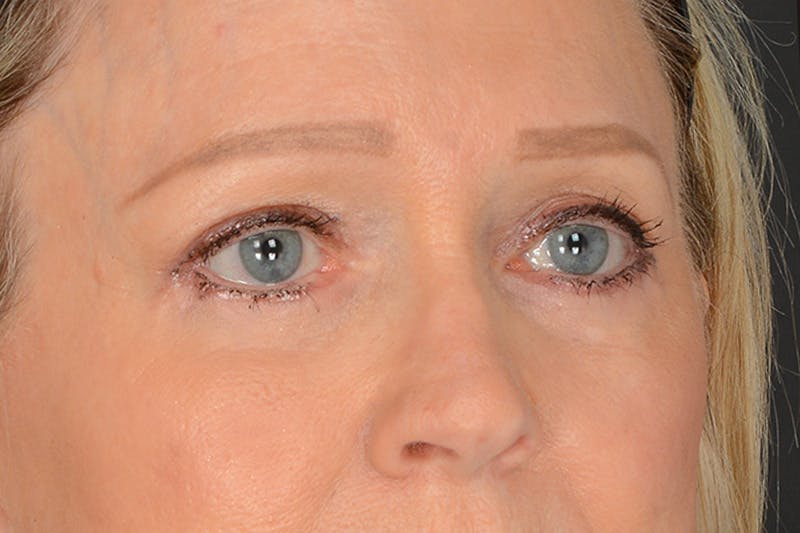 Blepharoplasty Before & After Gallery - Patient 797407 - Image 4