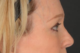 Blepharoplasty Before & After Gallery - Patient 165625802 - Image 6
