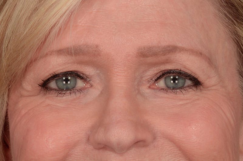 Blepharoplasty Before & After Gallery - Patient 165625802 - Image 7