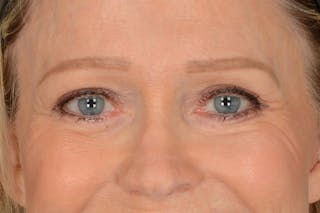 Blepharoplasty Before & After Gallery - Patient 165625802 - Image 8