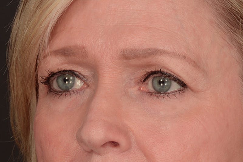 Blepharoplasty Before & After Gallery - Patient 797407 - Image 9