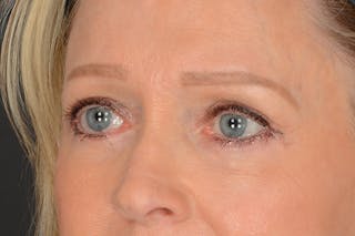 Blepharoplasty Before & After Gallery - Patient 797407 - Image 10