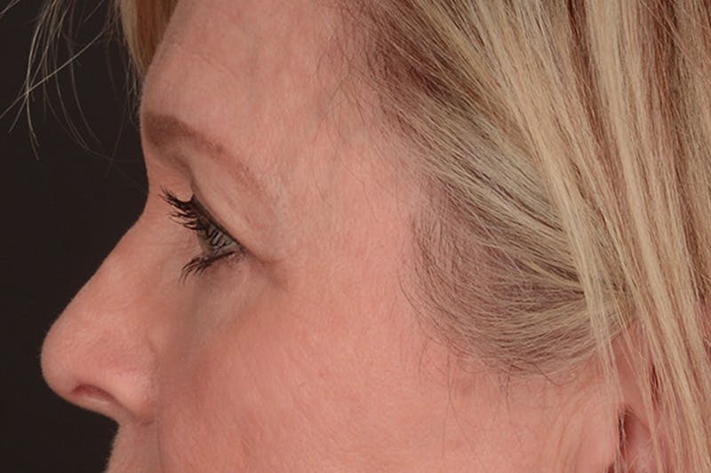 Blepharoplasty Before & After Gallery - Patient 165625802 - Image 11