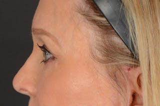 Blepharoplasty Before & After Gallery - Patient 797407 - Image 12